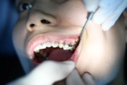 dental-fillings